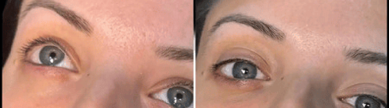 Dermal Fillers